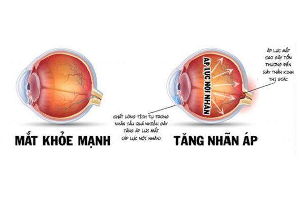 Biến chứng mắt ở tiểu đường