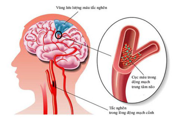 đột quỵ